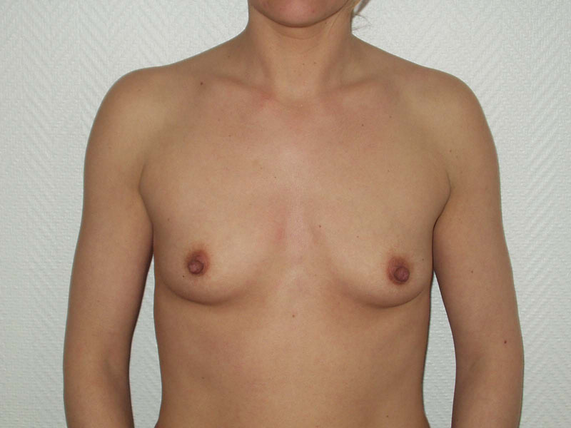 Augmentation des seins - avant