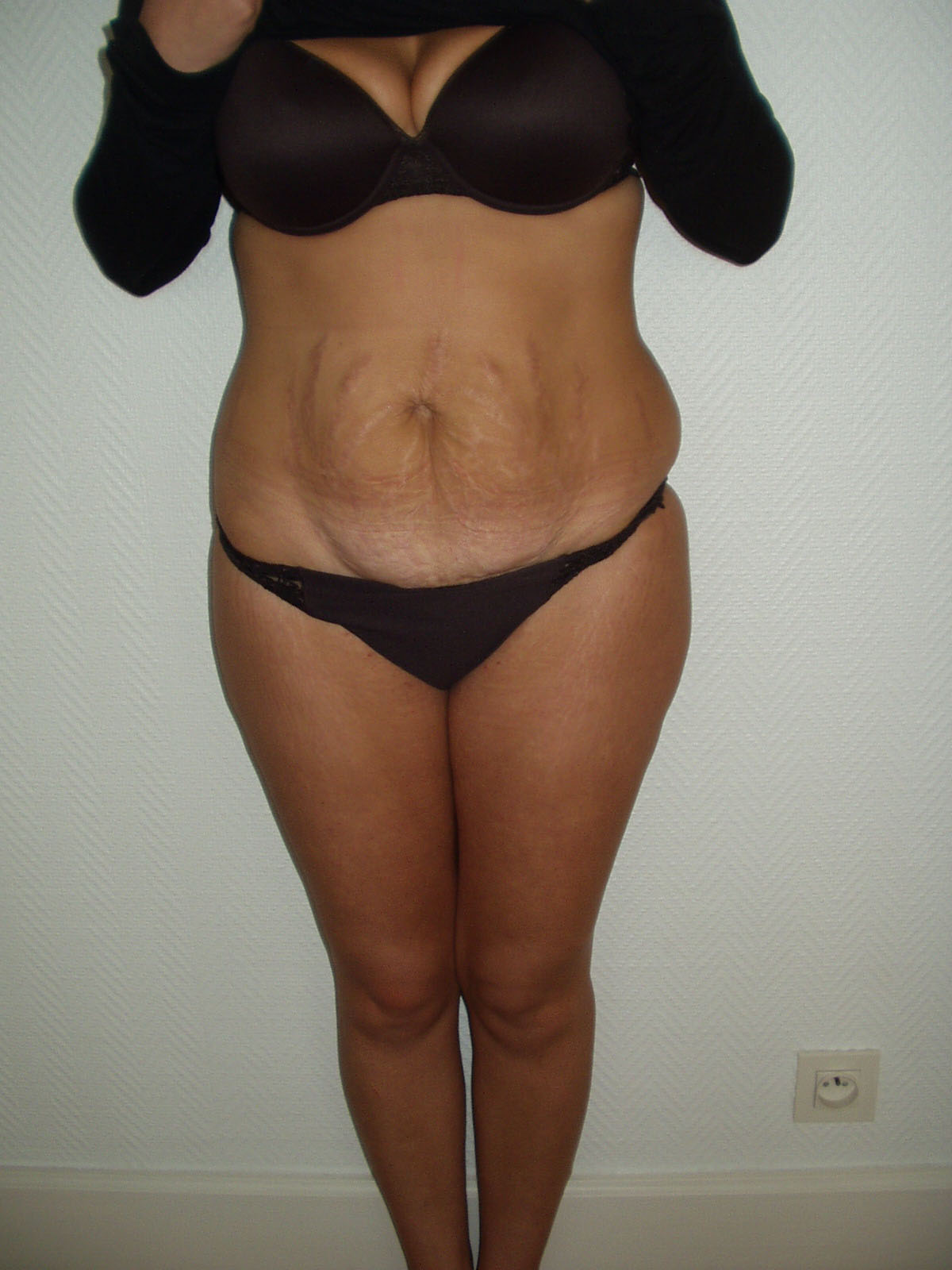 Pas de prise en charge possible par l'AM Abdominoplastie-DE refusée