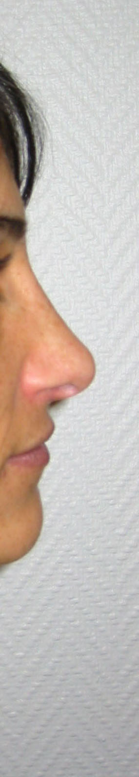 RHINOPLASTIE POSTOP 8 MOIS