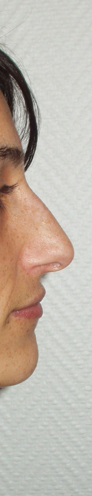 RHINOPLASTIE PREOP