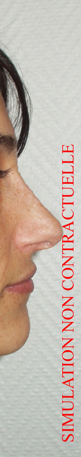 RHINOPLASTIE SIMULATION