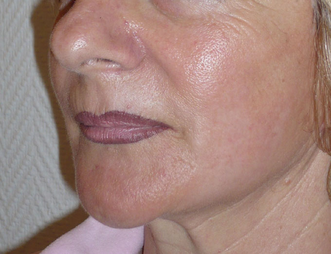 Peeling au phenol
