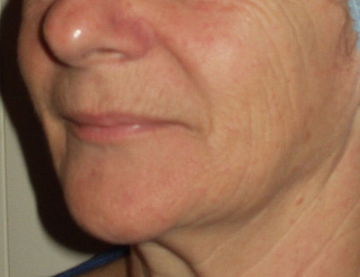 Peeling au phenol