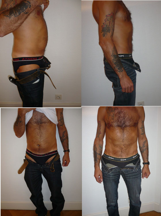 Lipoaspiration avant-après Lipomatic°