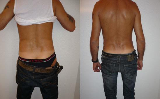Lipoapiration Lipomatic° Avant-après