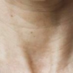 Mésothérapie anti-âge avant
