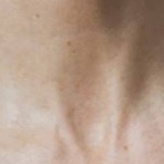 Mésothérapie ant-âge après