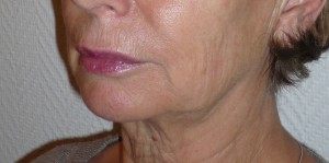 VOLUMA1 VOLUMA AVANT INJECTION