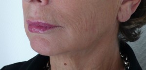 VOLUMA2 VOLUMA APRES INJECTION