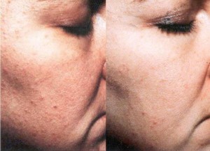 Peeling TCA avant-après Peeling TCA avant-après