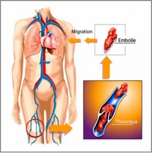 Chirurgie esthétique et thrombose veineuse Thrombose veineuse