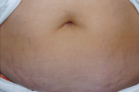VERGETURES ABDOMINALES - Avant VERGETURES ABDOMINALES - Avant