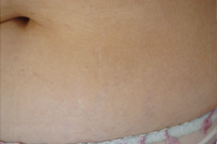 VERGETURES ABDOMINALES - Après VERGETURES ABDOMINALES - Après