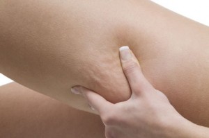 cellulite primaire ou capiton ou peau d'orange cellulite