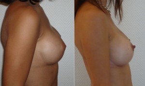 Implant rond versus implant anatomique Implant rond versus implant anatomique