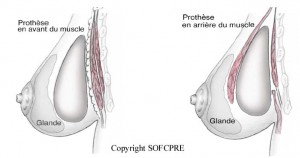 prothèses mammaires en avant et en arrière du muscle grang pectora prothèses mammaires en avant et en arrière du muscle grang pectora