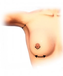 AUGMENTATION MAMMAIRE: VOIES D'ABORD AUGMENTATION MAMMAIRE: VOIES D'ABORD