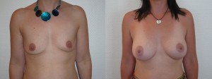 Augmentation mammaire - implants anatomiques - voie sous mammaire Augmentation mammaire - implants anatomiques - voie sous mammaire
