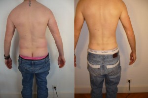 Resultat lipo homme dos