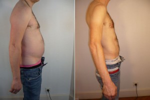 Resultat lipo homme profil