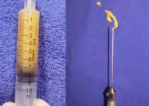 Lipostructure ou lipofilling Lipostructure ou lipofilling