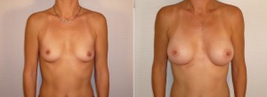 AUGMENTATION MAMMAIRE LYON IMPLANTS ANATOMIQUES