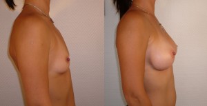 AUGMENTATION MAMMAIRE LYON IMPLANTS ANATOMIQUES