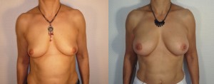 AUGMENTATION MAMMAIRE LYON IMPLANTS ANATOMIQUES