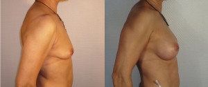 AUGMENTATION MAMMAIRE LYON IMPLANTS ANATOMIQUES