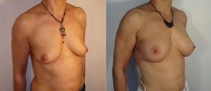AUGMENTATION MAMMAIRE LYON IMPLANTS ANATOMIQUES