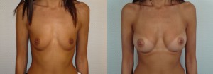 AUGMENTATION MAMMAIRE LYON IMPLANTS ANATOMIQUES