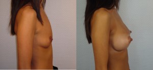 AUGMENTATION MAMMAIRE LYON IMPLANTS ANATOMIQUES