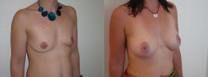 AUGMENTATION MAMMAIRE LYON IMPLANTS ANATOMIQUES