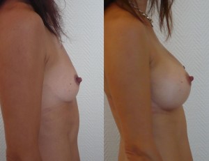 AUGMENTATION MAMMAIRE LYON IMPLANTS ANATOMIQUES