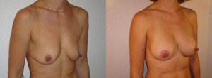 AUGMENTATION MAMMAIRE LYON IMPLANTS ANATOMIQUES