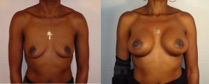 AUGMENTATION MAMMAIRE LYON IMPLANTS ANATOMIQUES