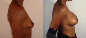 AUGMENTATION MAMMAIRE LYON IMPLANTS ANATOMIQUES
