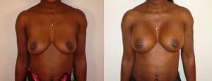 AUGMENTATION MAMMAIRE LYON IMPLANTS ANATOMIQUES
