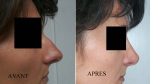 RHINOPLASTIE AVANT - APRES RHINOPLASTIE AVANT - APRES