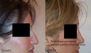 RHINOPLASTIE MICRO-BOSSE PERSISTANTE RHINOPLASTIE MICRO-BOSSE PERSISTANTE
