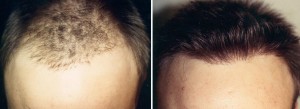 greffe cheveux avant apres greffe cheveux avant apres