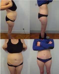 Abdominoplastie Lyon Saint Etienne avant-après