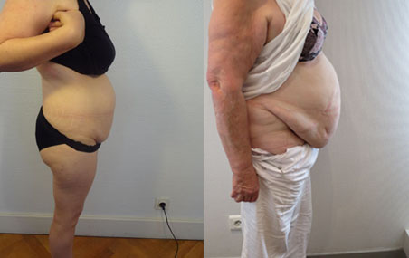 chirurgie plastique lyon, chirurgie plastique Saint Etienne, chirurgie esthetique lyon, chirurgie esthetique Saint Etienne, abdominoplastie lyon, abdominoplastie Saint Etienne, augmentation mammaire lyon, augmentation mammaire st etienne, rhinoplastie lyon, rhinoplastie st etienne, dr van der stegen