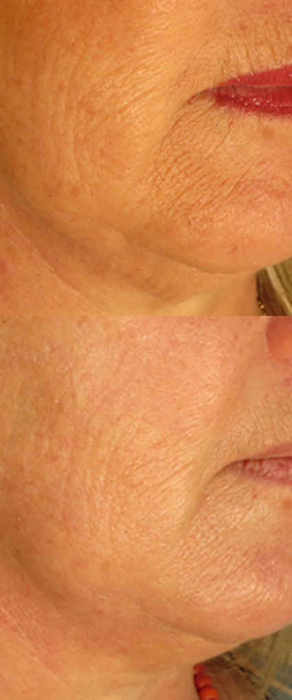 Volite, acides hyaluronique, comblement rides, médecine esthétique, juvederm, stylage