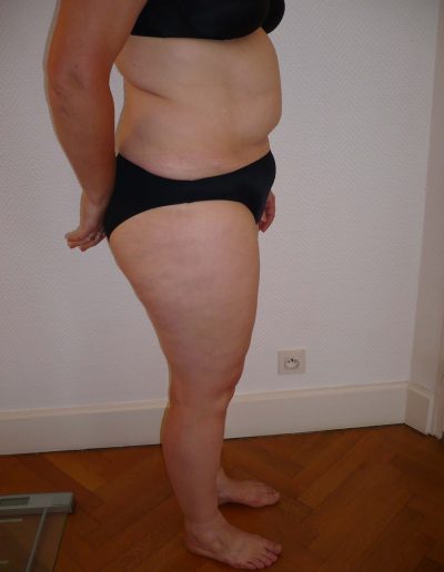 photo lipoaspiration avant