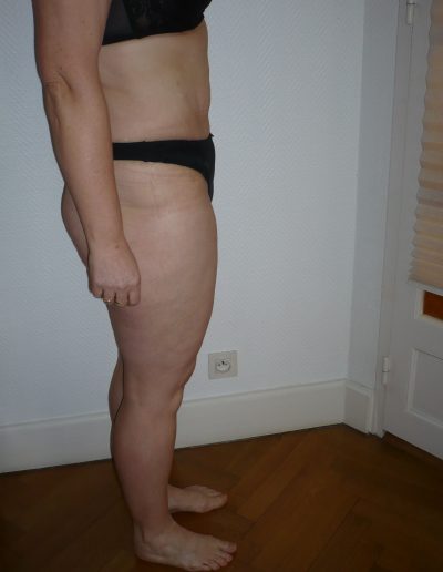 photo lipoaspiration après