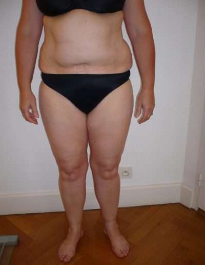 photo lipoaspiration avant
