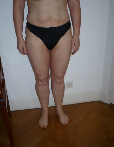 photo lipoaspiration après
