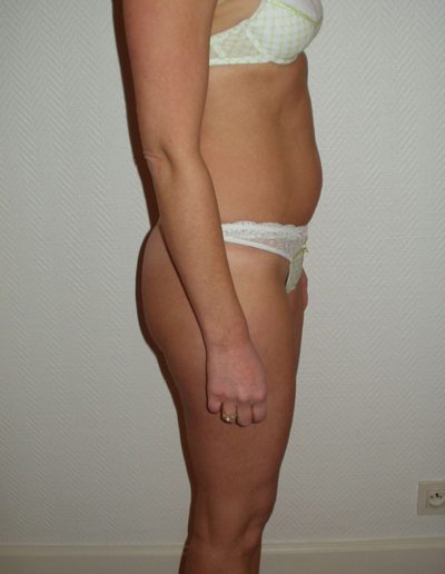 photo lipoaspiration avant