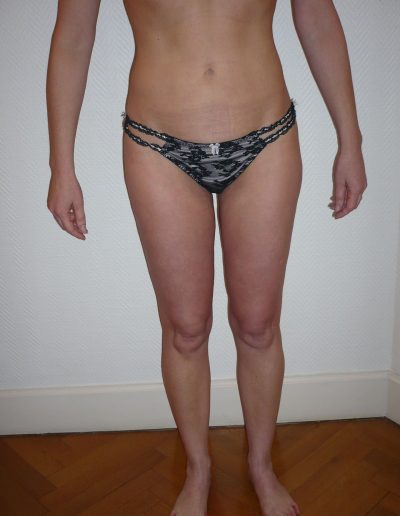 photo lipoaspiration après